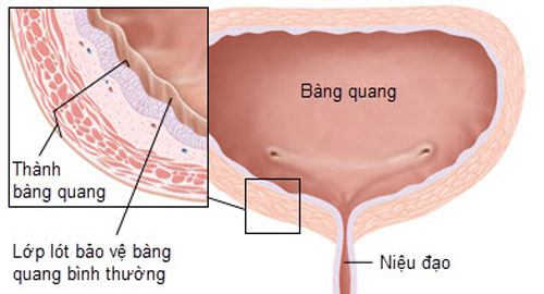 Bệnh viêm bàng quang là gì?