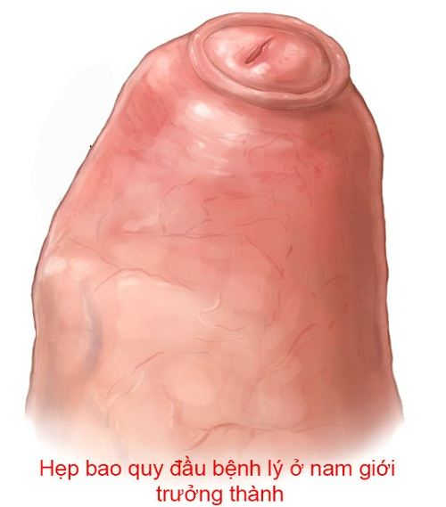 Biểu hiện của hẹp bao quy đầu