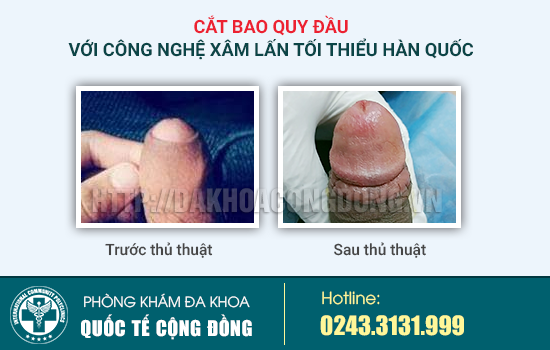 Cách chữa hẹp bao quy đầu
