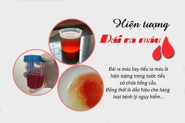 Tiểu ra máu do mắc bệnh gì, có nguy hiểm tới sức khỏe không?