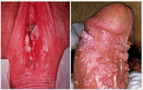 Triệu chứng của bệnh sùi mào gà khi mới bị